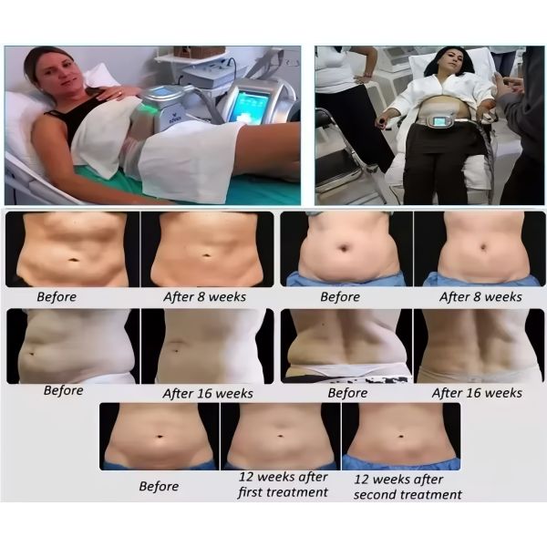 Tabletop Fat Freezing Cryolipolysis Machine 600W For Beauty Salon / Aesthetic Studio