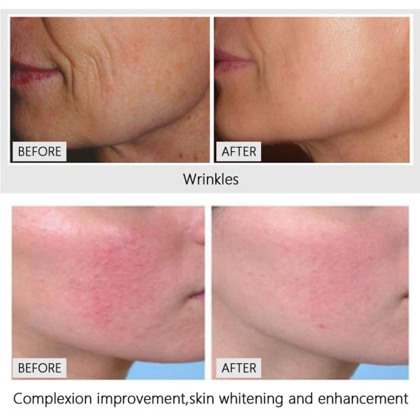 Q-Switch NO Fractional Co2 Laser for Laser Vaginal Tightening Machine Wrinkle Remover