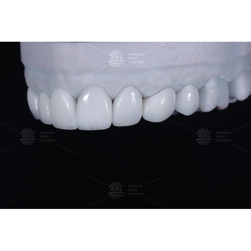 China Dental Lab High Esthetics Translucency EMAX Veneer with 0.3-0.5mm Thickness for Anterior and Posterior Restorations