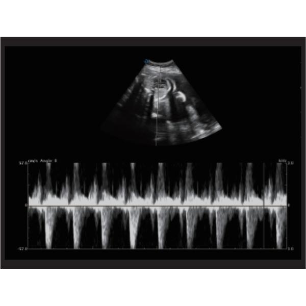 Fetal Doppler Medical Ultrasound Machine Trolley 3D 4D 5D