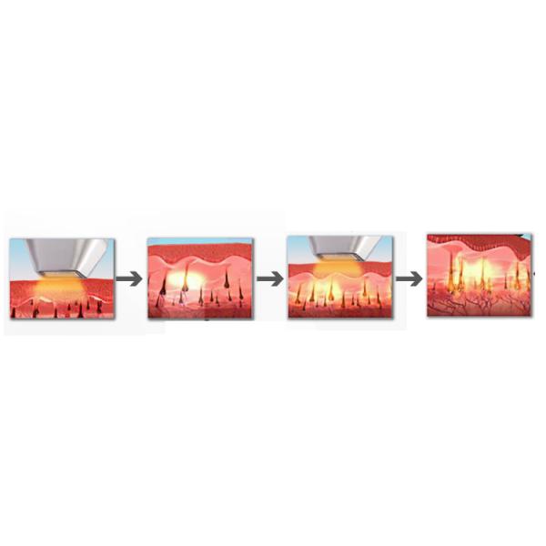 600W 2000W 808nm Diode permanente machine d'épilation au laser avec double poignée