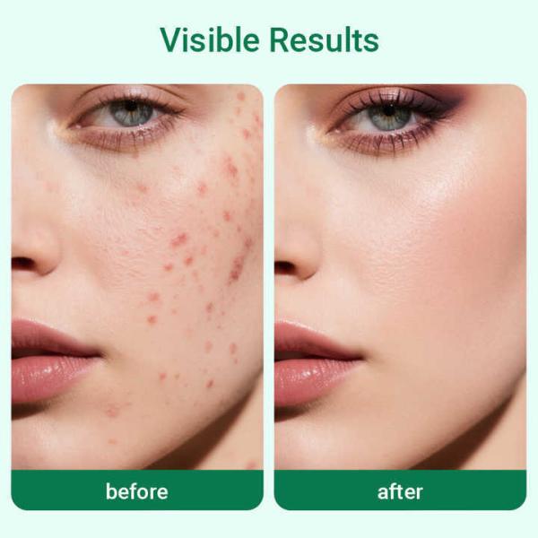 Anti Acne Ceramide NP Sodium Hyaluronate Facial Skincare Set Black Spot Whitening