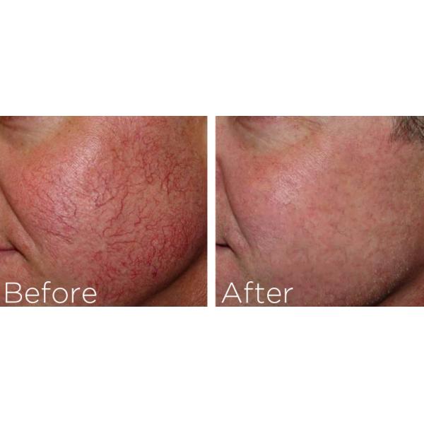 Blood vessels / spider vein removal machine for home remedy with touch screen