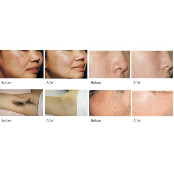 610nm IPL Skin Rejuvenation Machine Opt Shr Hair Removal For Clinic