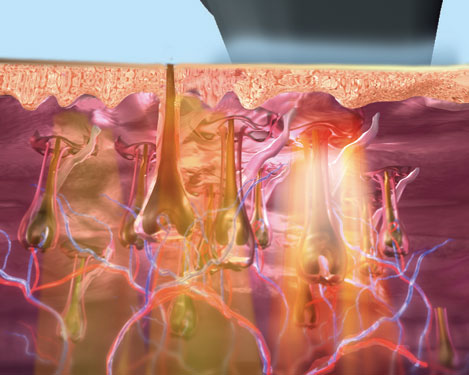 Germany imported xenon lamp SHR Elight 3 In 1 FMS-1 ipl shr hair removal machine for sale