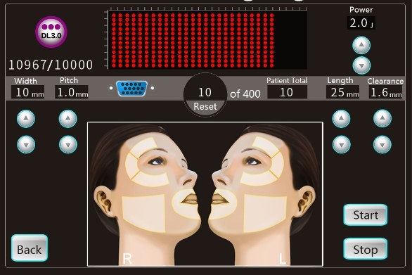 оборудование подтяжки лица 4D Hifu не хирургическое