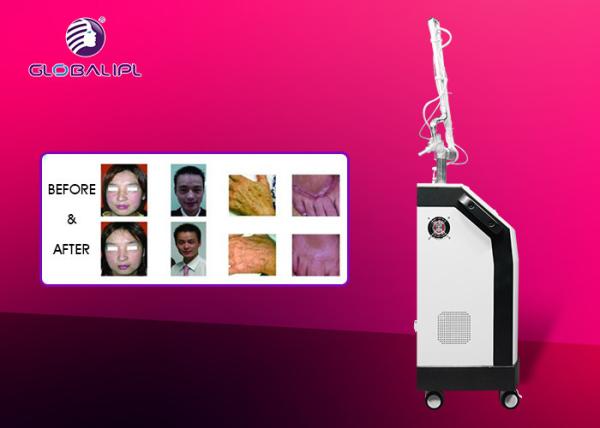 Acne And Acne Scar Removal CO2 Fractional Laser Machine With Air Cooling System