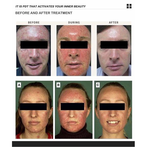 5 Color PDT LED Phototherapy Machine 420nm 520nm 590nm 633nm 850nm