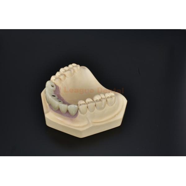 Titanium Implant Bridge Dental Durable Solution Teeth Implant Bridge