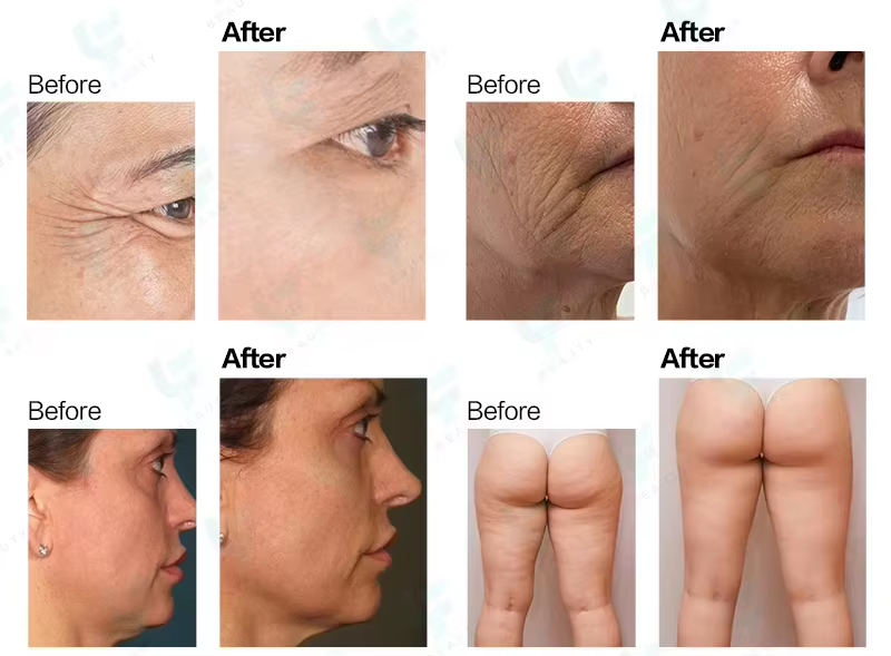 22D HIFU Face And Body Machine 1200W For Face Lift / Body Contouring