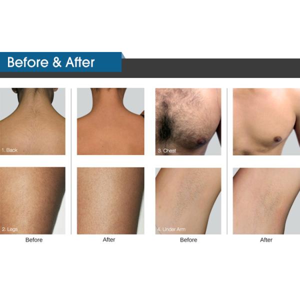 ADSS Hair Removal 808nm Diode Laser Salon Use Laser Hair Removal Machine With Skin Rejuvenation Laser