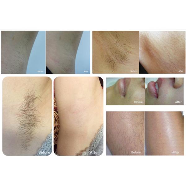 1200w 2 In 1 IPL OPT SHR Portable Nd Yag Laser Tattoo Removal Equipment