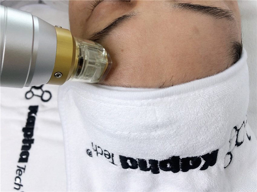 Термальный охлаждая подниматься стороны Microneedling частичный RF 10,4 дюймов