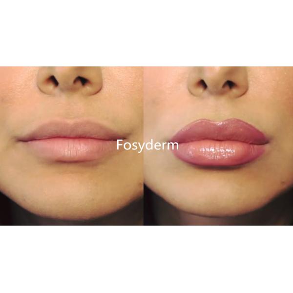 Укреплять Hyaluronic кисловочный дермальный уход за лицом заполнителя складывает вызревание удаления анти-