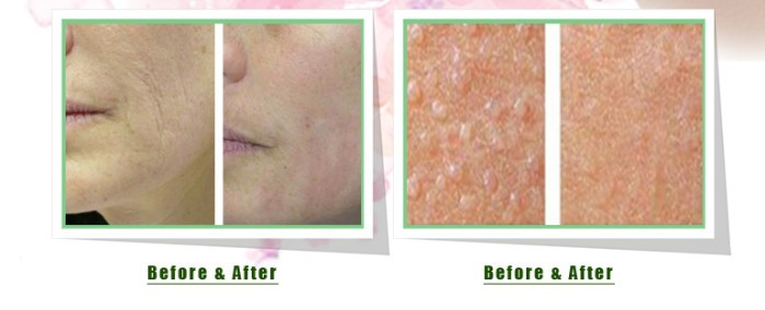 1550nm Er Yag Лазерная машина Erbium Glass Fractional Laser Resurfacing Machine
