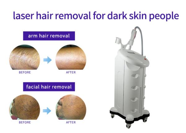 Solid State Laser Hair And Tattoo Removal Machine , Industrial Laser Hair Removal Machine