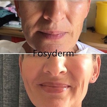 1ml 2ml 10ml Injectable Dermal Filler , Cross Linked Hyaluronic Dermal Fillers Ha