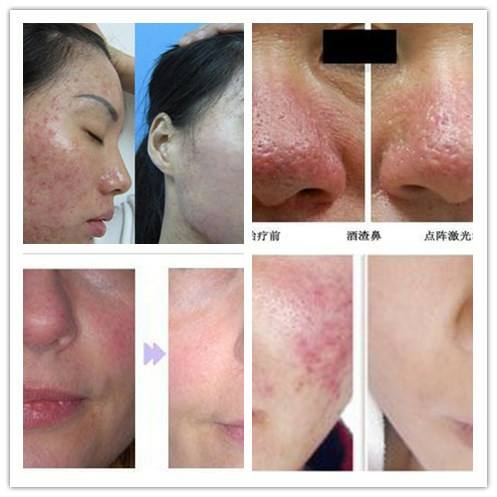 Powerful 50W RF CO2 Fractional Laser Machine Scar Removal High Efficiency