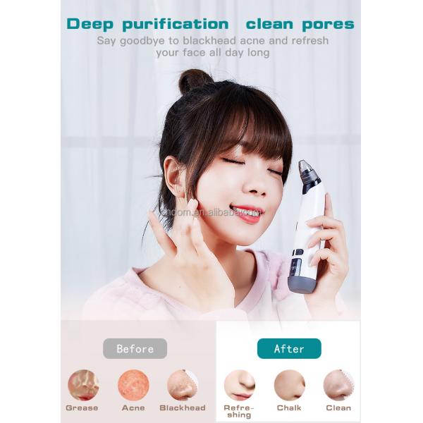 Electric Whitehead And Pimple Removal Vacuum Suction Instrument for Effective Solution