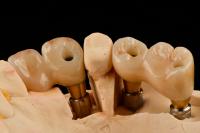 Self Tapping 3.0mm Thread Dental Titanium Implant Optimized Functionality