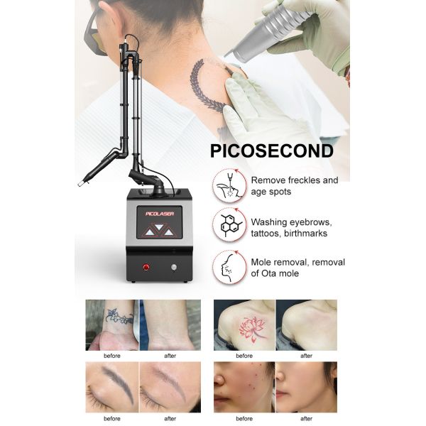 Powerful Pico Laser Tattoo Removal Machine Pigmentation Beauty 1500W