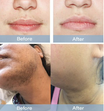 Pain Free 810nm Diode Laser Device Permanent Hair Removal Equipment