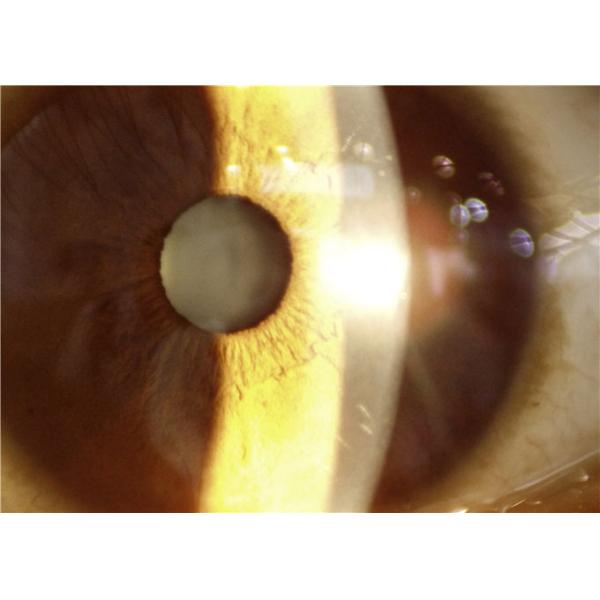 Оборудование офтальмологии заболеванием 10X цифров диагноза Anterior