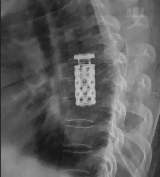 Black / Blue Cornerstone Peek Cage , Expandable Titanium Spinal Cage