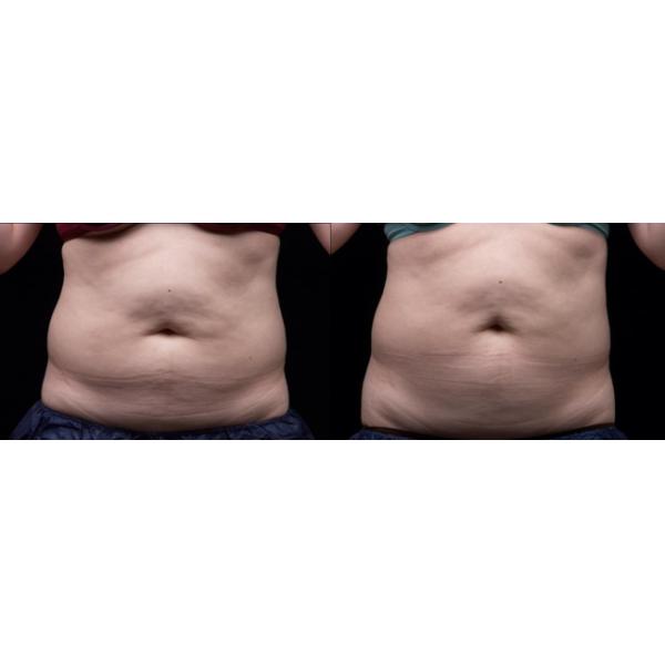 Не инвазионное тело контуря ультразвуковую машину удаления волос кавитации липосакции для дам