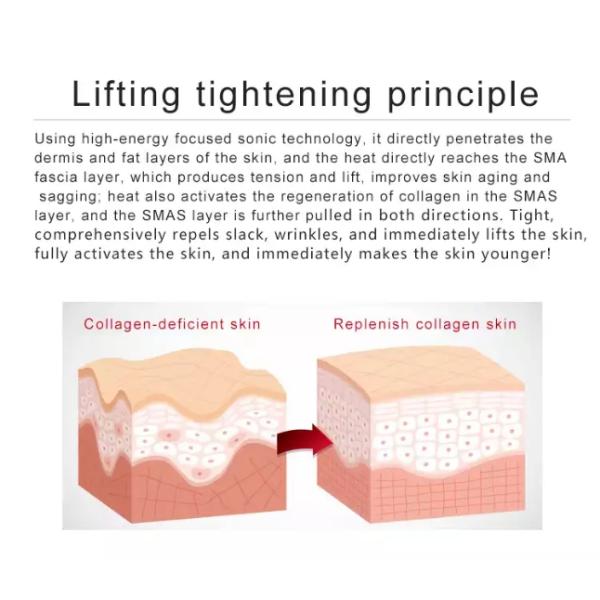 3D High Intensity Focused Ultrasound Face Lift Machine For Double Chin