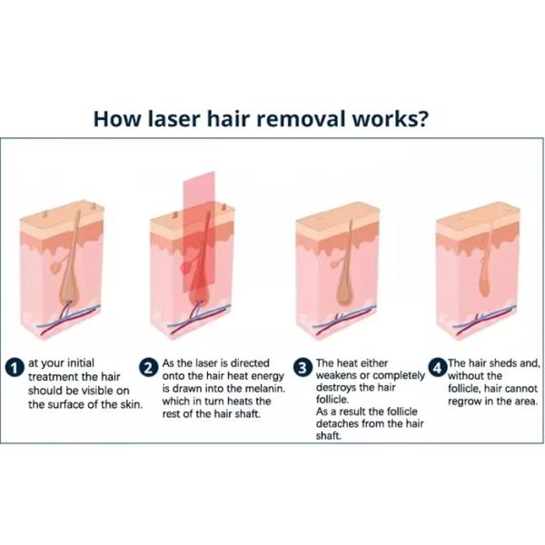 Les machines IPL portables pour éliminer les pores du corps et du visage