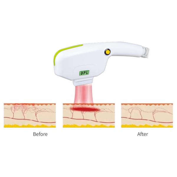 3000W 2 Handles DPL NIR Skin Rejuvenation Fast Hair Removal Machine