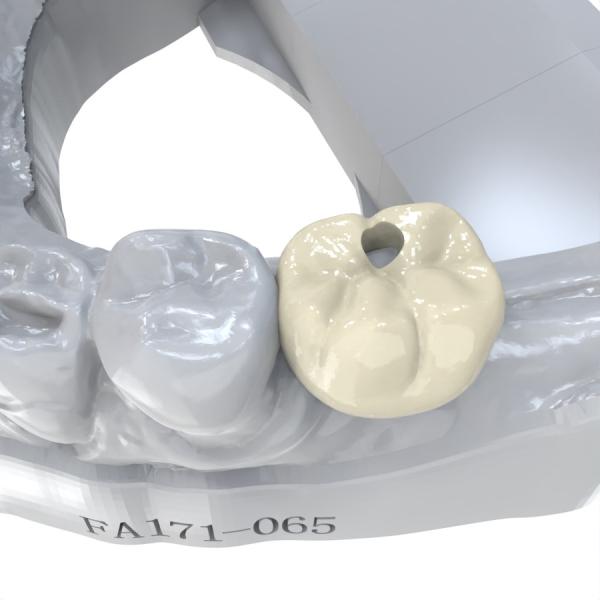 Long-Lasting Low Water Absorption Permanent Crown Resin for Porcelain-Filled Metal PFM Crowns