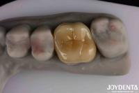 Medium Translucency Emax Inlay Onlay Easy Cleaning And Non-toxic Biocompatibility In Materials