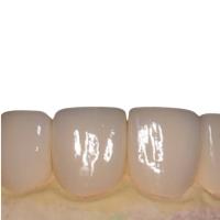 Smooth Porcelain Teeth Veneers No Irritation Beautiful White Porcelain Veneers
