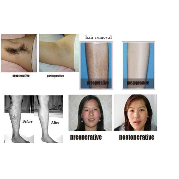 Лазер 1064 яг нд машины удаления татуировки лазера НД ИАГ ИМПа ульс клиники регулируемый