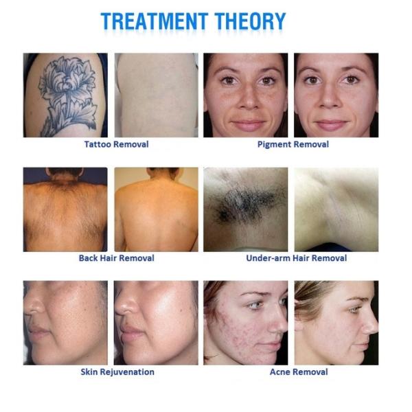 Opt Shr Ipl Hair Removal equipment Radio Frequency Facial Laser Tattoo Removal 3 In 1 Machine