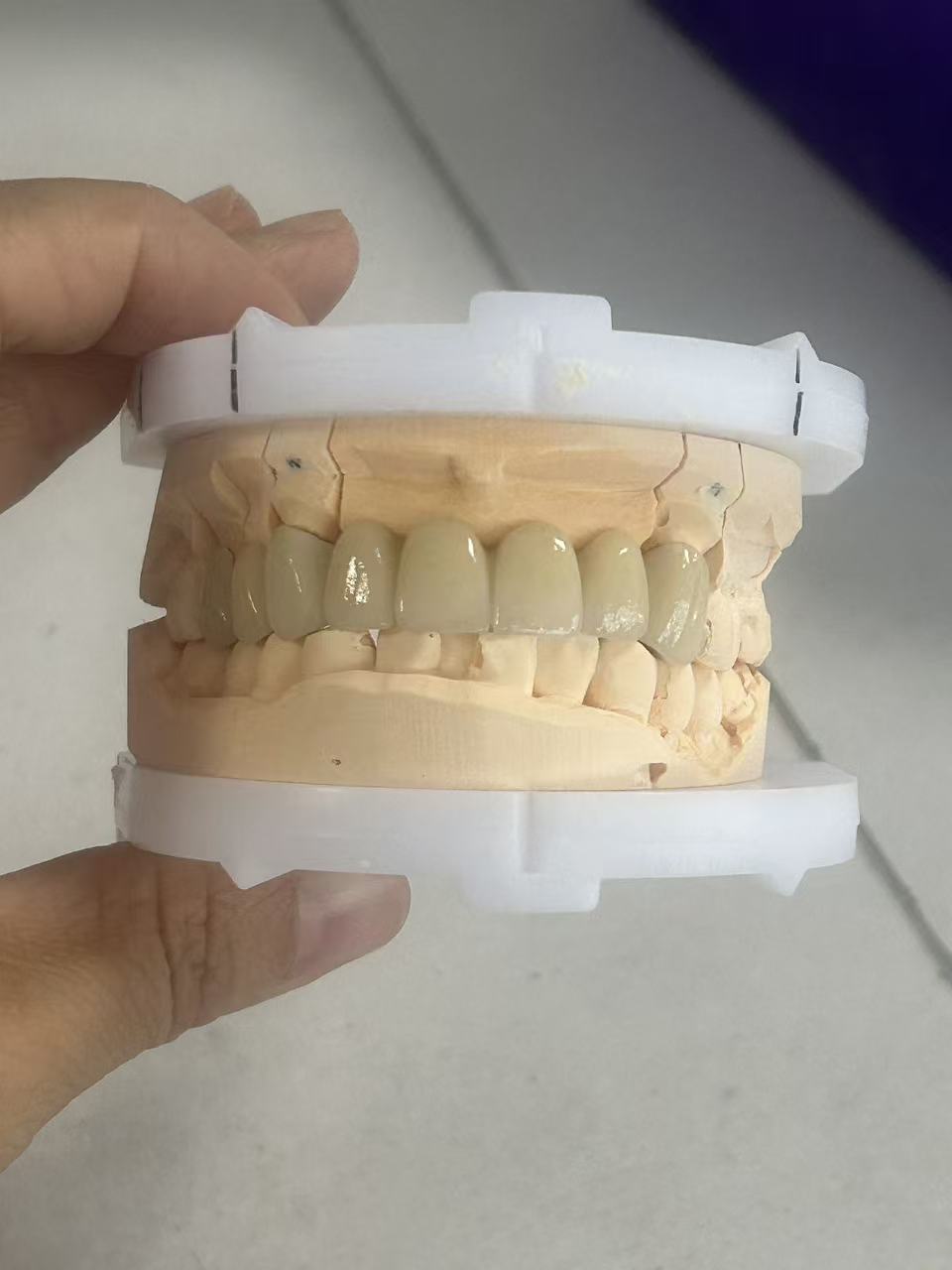 High Fracture Resistance Full Zirconia Dental Crown with Natural Translucency and CAD/CAM Digital Production
