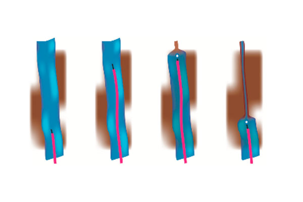 810nm 980nm Medical Laser Machine Local Anesthesia EVLT