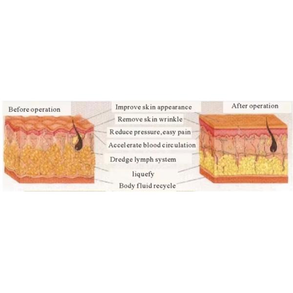 448khz Cet Ret Resistive RF Pain Relief Tecar Therapy Machine