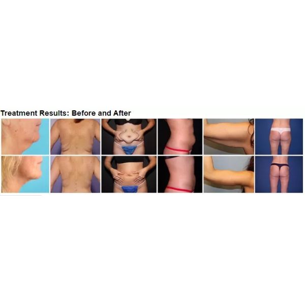 5 IN 1 40k cavitation vacuum body slimming RF body shaping beauty equipment BS09