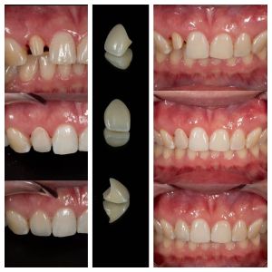 Prothèses en zirconium qui imitent les dents naturelles