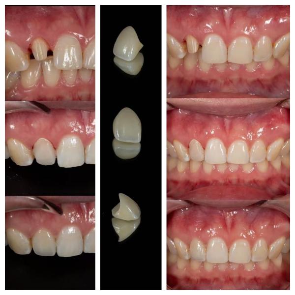 Zirconia Dental Crowns Fabrication Lab | Precision Crown Outsourcing - Joydentalab