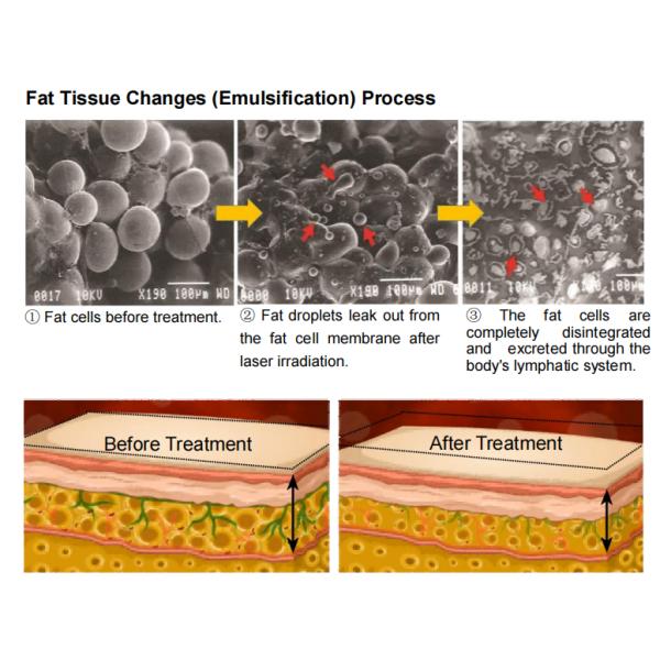 Luxmaster Vacuum Lipo Máquina de adelgazamiento láser para la escultura del cuerpo células grasas de destino con 532nm luz verde y terapia de rodillos