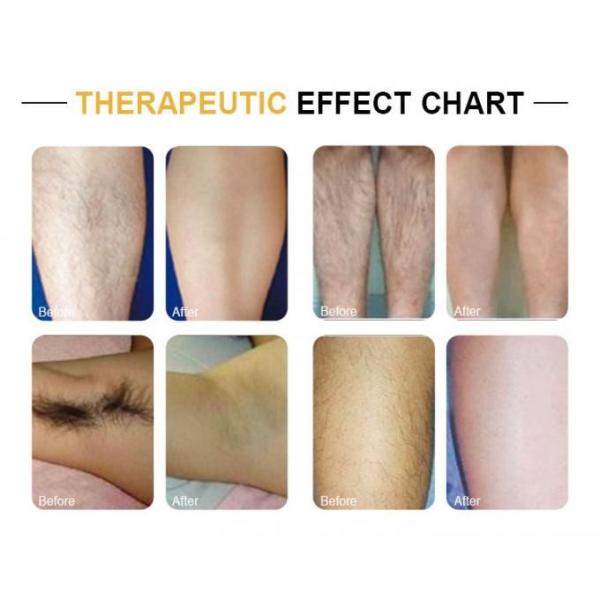 Безболезненное удаление Германия волос лазера диода 600W 808nm