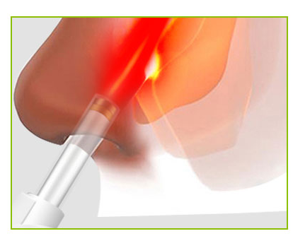 3.7V 4.2V Allergic Rhinitis Laser Treatment Machine For Nose Blood Congestion