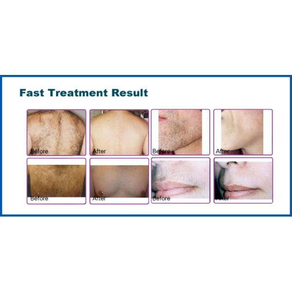 Effective Safe Ipl Beauty Machine For Skin Tightening and Hair Removal