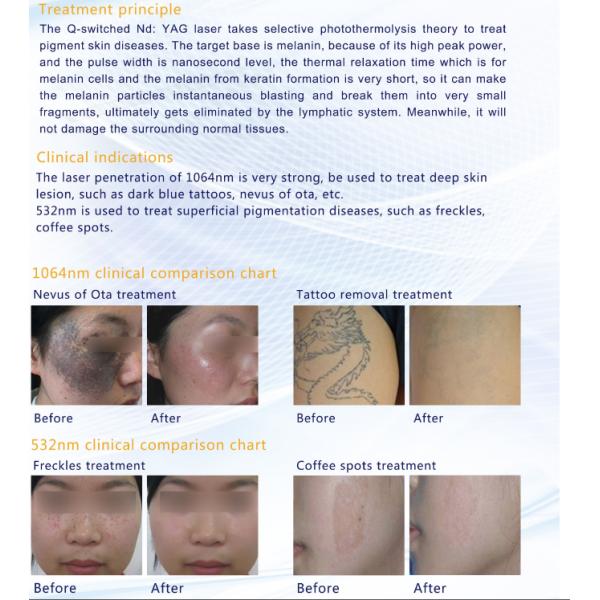 FDA and Medical CE approved Q Switched Nd yag laser for tattoo removal,birthmark.pigmentation removal dermatologist