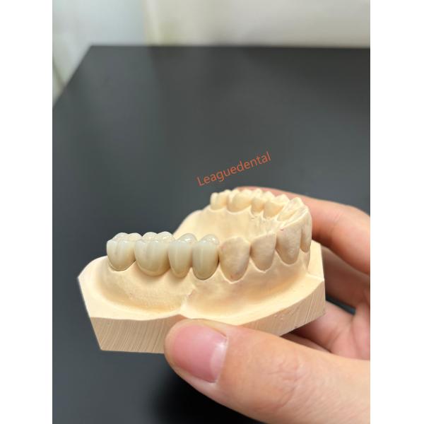 Precision Porcelain Metal Crown PFM Crown For Durable Dental Restorations
