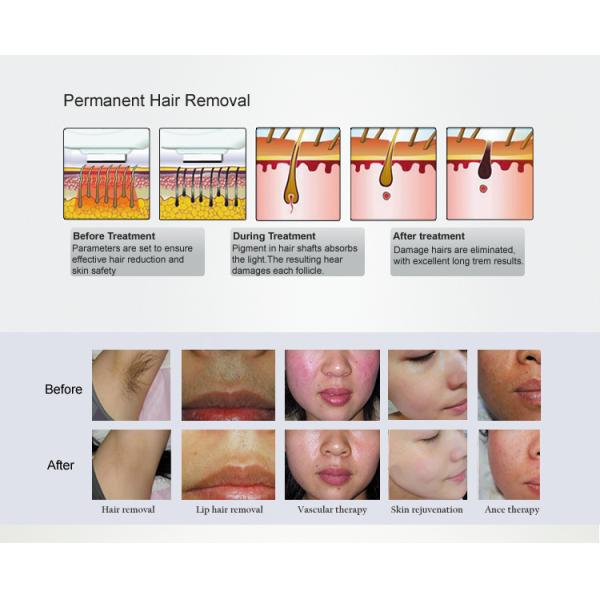 Машина депиляции прибора удаления волос лазера OPT Shr Elight IPL постоянная